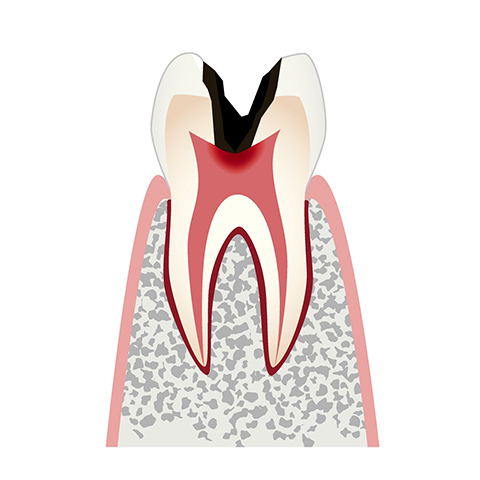 C3 歯髄の虫歯